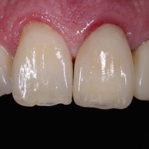 Corona e-max en 21 Corona e-max en 21