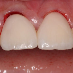 Dos incisivos empastados despues del tratamiento Dos incisivos empastados