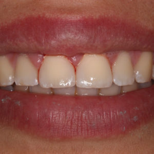 Dos incisivos empastados Dos incisivos empastados