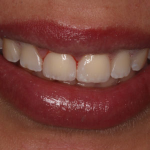 Dos incisivos empastados Dos incisivos empastados